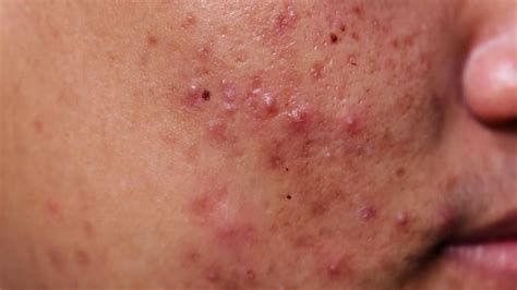 The DOM would place about 4-5 needles around each cyst or pimple. . Popping cystic acne with needle